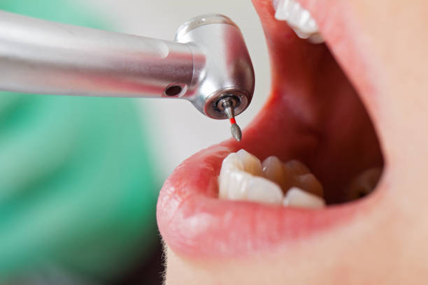 Best Dental Abscess Treatment in New Hackensack, NY